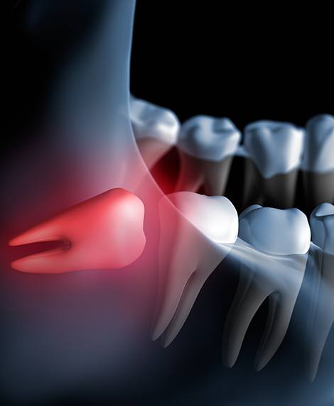 Animated smile with an impacted wisdom tooth