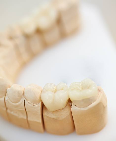 Model of the mouth with dental inlay and onlay restorations