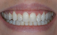 Flawless smile after Six Month Smiles orthodontics