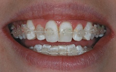 Teeth with Six Month Smiles orthodontics