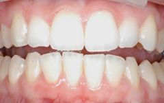 Teeth before Six Month Smiles