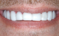 Perfected smile after dental snap on treatment