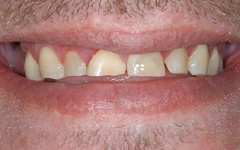 Worn discolored teeth before dental snap on treatment