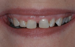 Gapped teeth and imperfect smile before dental snap on case