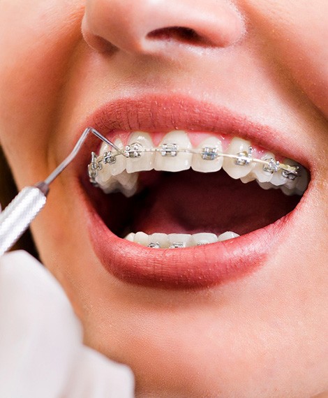 Nose-to-chin view of woman’s braces being examined by orthodontist