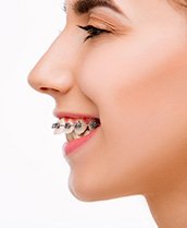 Profile nose-to-neck view of woman with braces on her overbite
