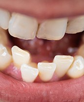 Closeup of crooked teeth in someone’s lower arch