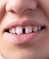 Closeup of woman with diastema in upper front two teeth