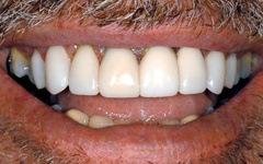 Gorgeous smile after veneers