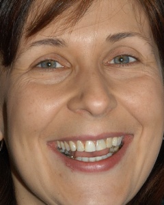 Woman sharing imperfect smile before veneers