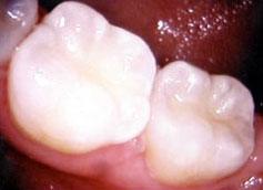 Teeth with tooth colored fillings