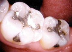 Teeth with metal fillings