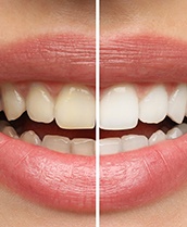 A smile before and after professional whitening