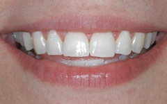 Brilliant smile after teeth whitening