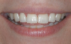 Discolored smile before teeth whitening
