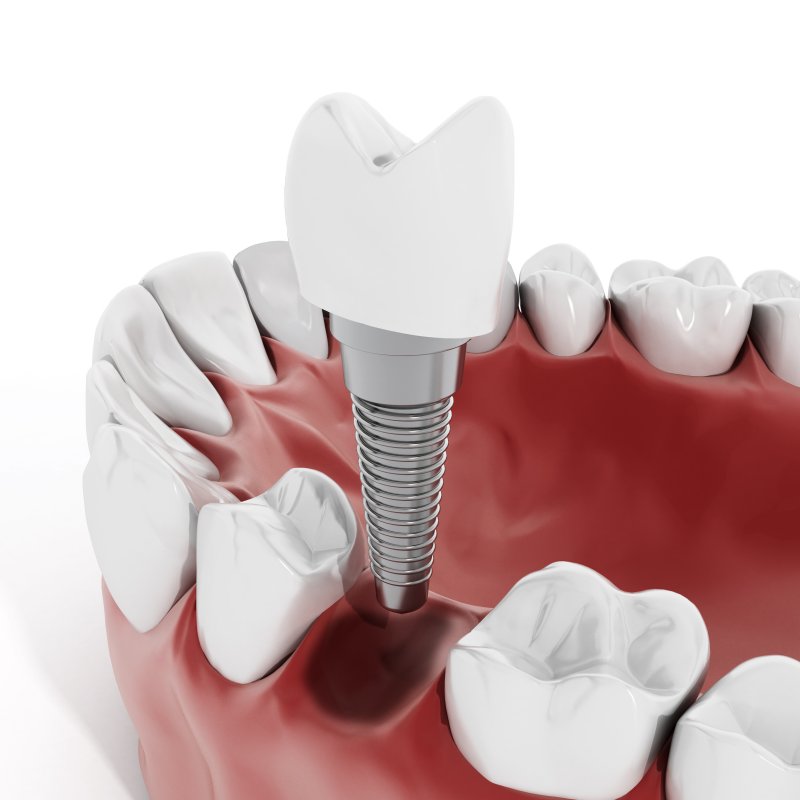 Dental implant being inserted into the lower jaw