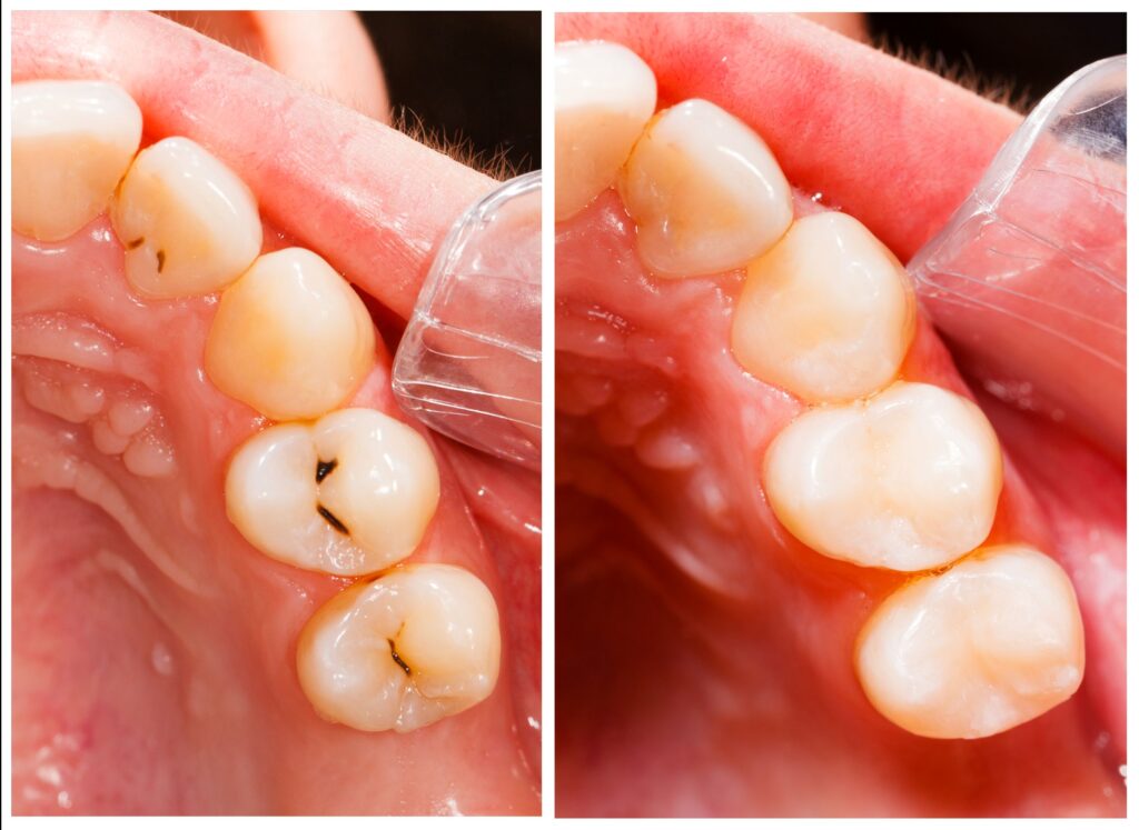 A tooth before and after getting a tooth-colored composite resin filling.