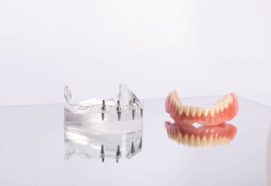 An All-on-4 implant denture